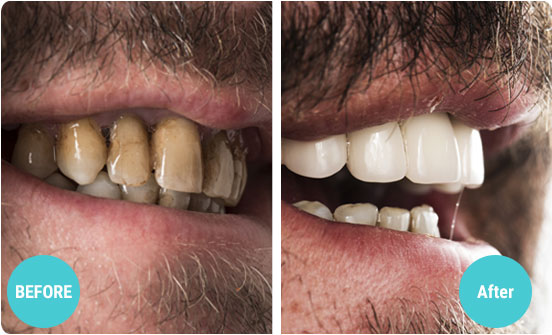 dental implant before after home