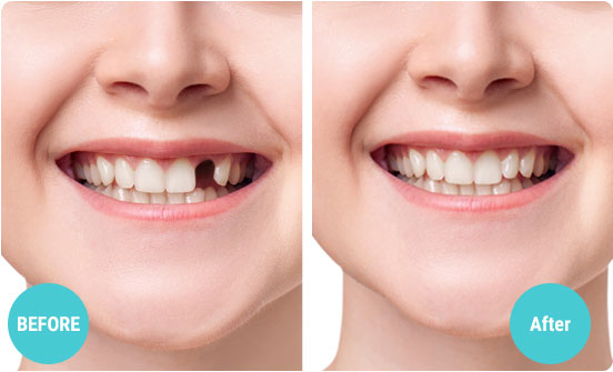 teeth before after home